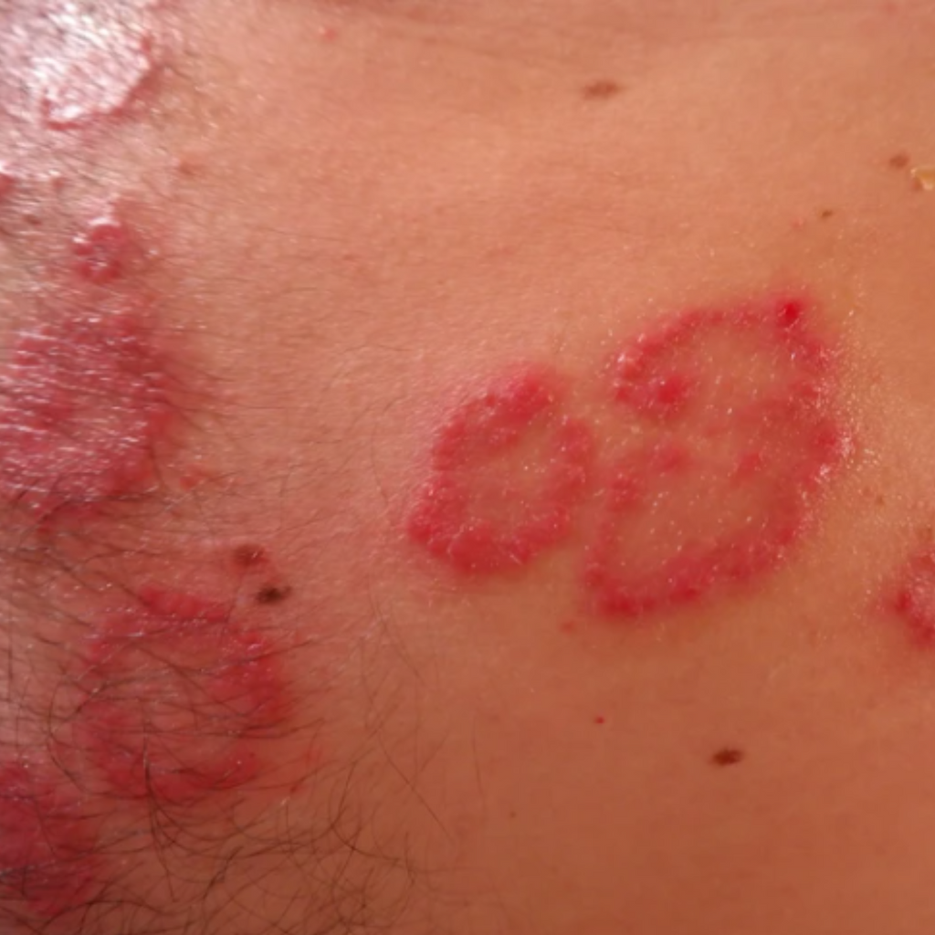 Why Conventional Treatments Fail: A Revolutionary Approach to Psoriasis Control