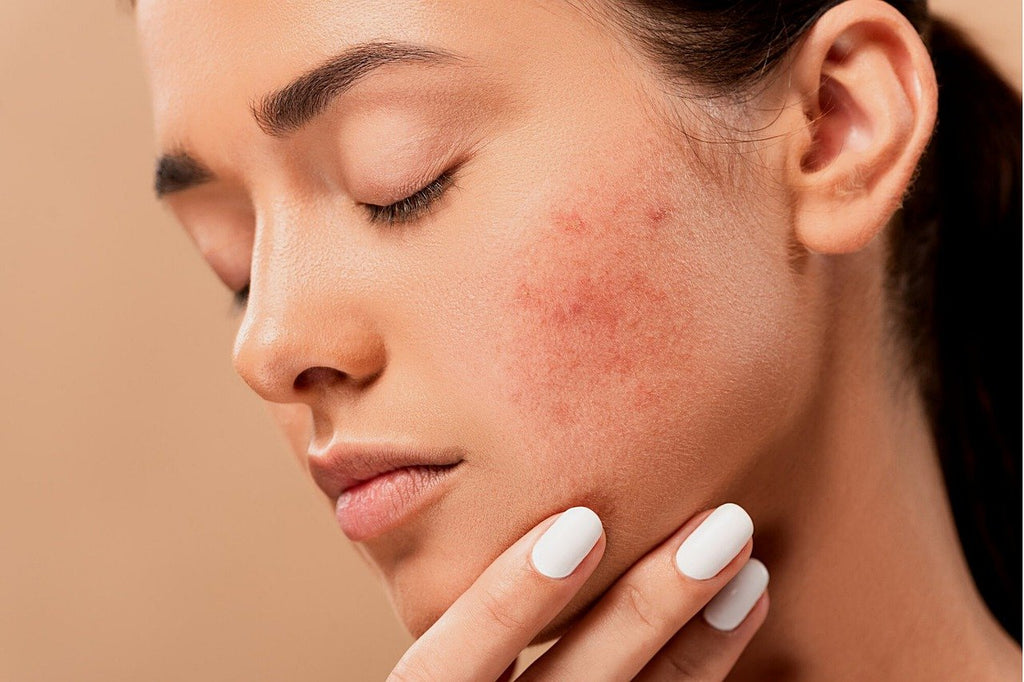 Common Acne Breakout Causes and How to Avoid Them