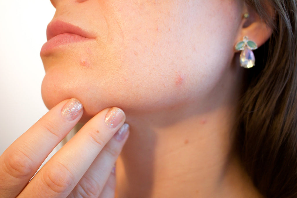 Understanding Chin Acne: Common Causes and Solutions