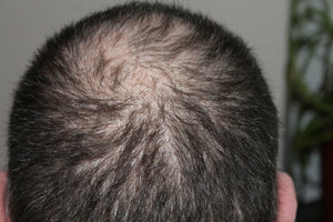 Hair Loss No More: Proven Techniques to Regain Your Hair