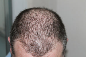 Can Stress Cause Loss Of Hair? Will It Grow Back?