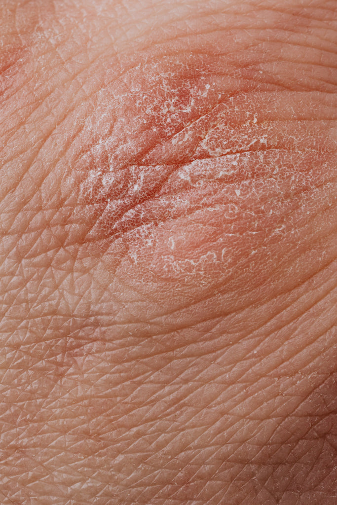Eczema Explained: How to Recognize Its Appearance