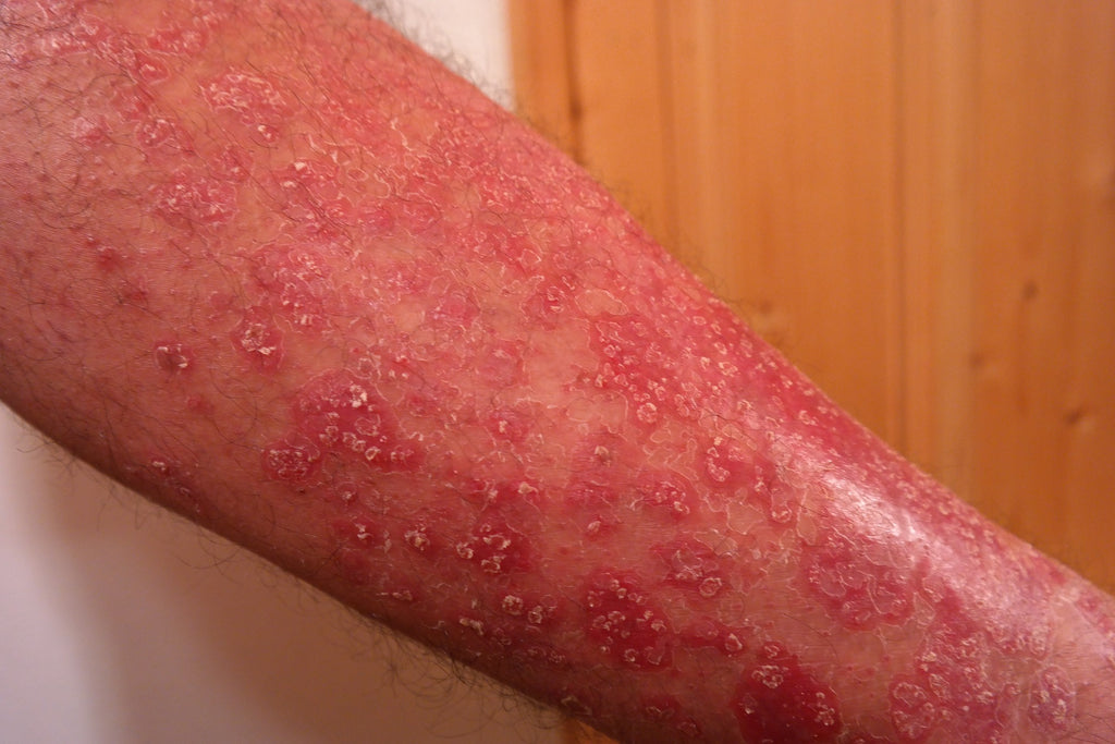 Psoriasis and Arthritis: How They're Connected and What You Need to Know