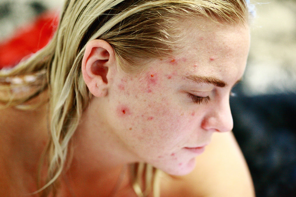 Clear Skin Ahead: 7 Tips for Managing Acne, Psoriasis, and Pimples