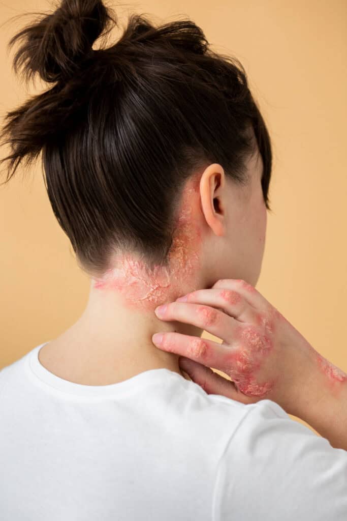 Dead Sea salts help eczema