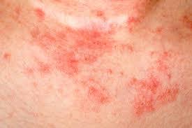 Is Eczema Hereditary