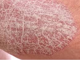 dead sea salt bath for psoriasis
