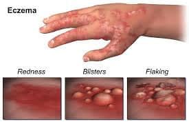 What is Eczema