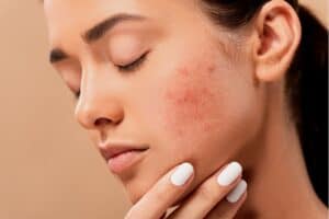 Close-up of a woman with acne-prone skin, demonstrating the benefits of Dead Sea cosmetics for skin clarity and health.