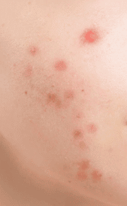 What Causes Pimples On The Face
