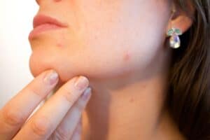 Acne remedies home