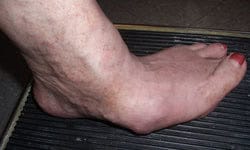 Dead Sea Treatment For Arthritis