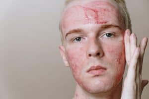 Best Treatment For Pimples And Acne