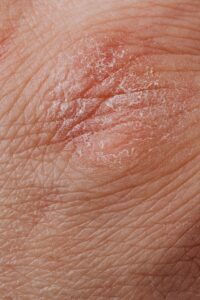 What is eczema looks like?
