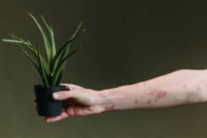 Aloe vera plant in a black pot being held by a person with psoriasis-affected skin on their arm.