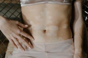 vitiligo cure