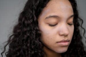 acne treatment diy