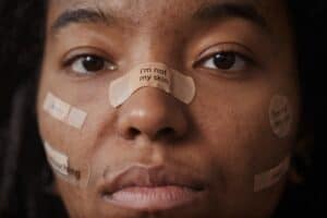 Acne face map meaning
