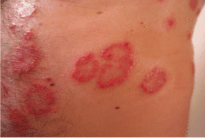 eczema and psoriasis pictures