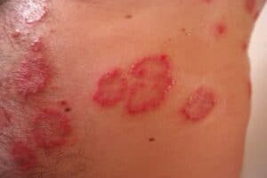 What psoriasis caused by