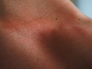 Why Treating Eczema?