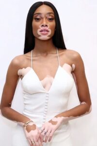 What Is Vitiligo?